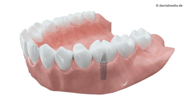 Krone Implantat getragen-Krone Vollkeramik