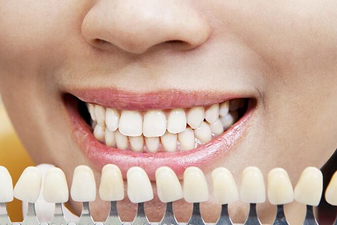 Alternative Methoden zur Zahnaufhellung – gibt es sie wirklich?