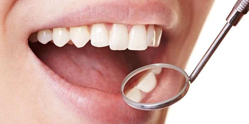 Karies lässt sich im Frühstadium ohne Bohrer behandeln