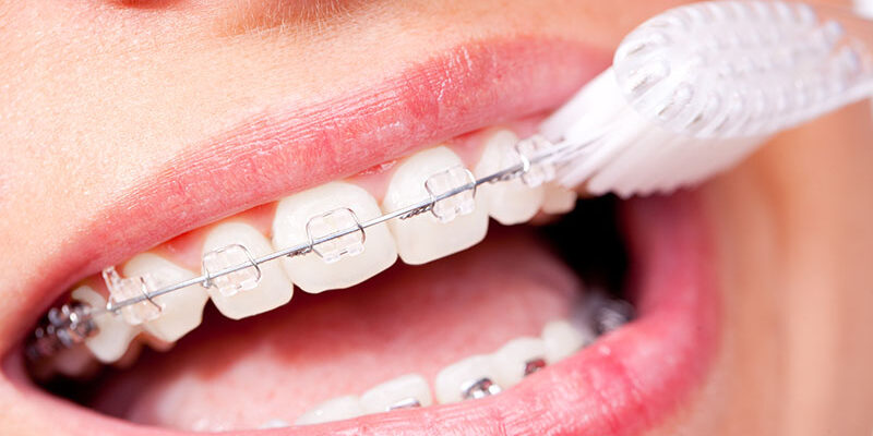Feste Zahnspange: So sollte man am besten die Zähne putzen