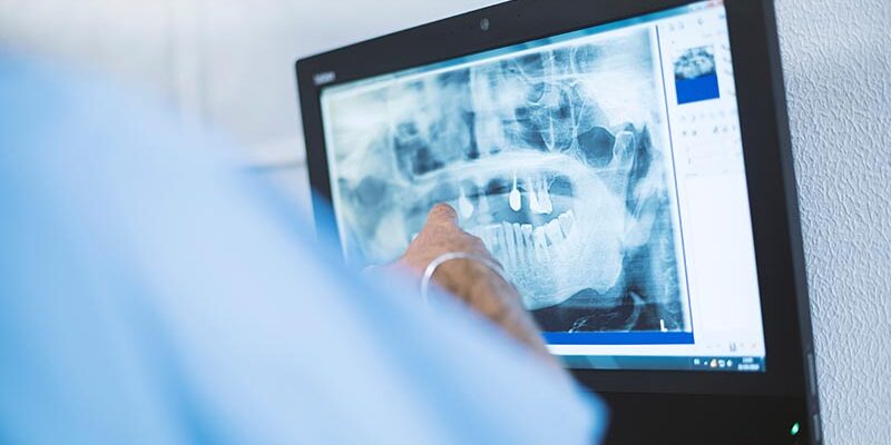 KI könnte bei der Röntgendiagnostik helfen